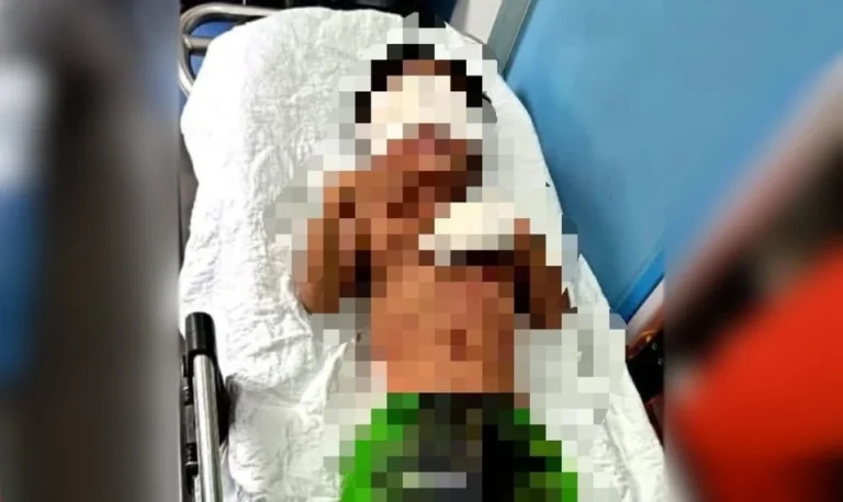 Mercun meletup : Budak 4 tahun putus jari